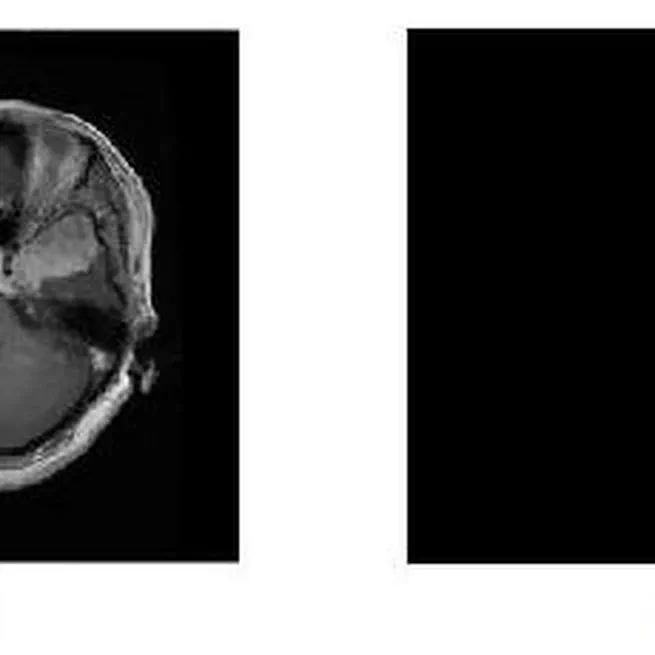 Retrieval of Brain Tumor with Region Based Image Segmentation